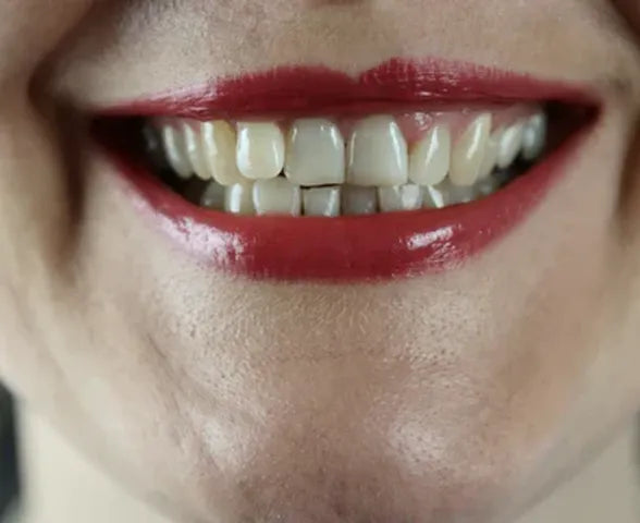 The Differences Between Tartar and Plaque