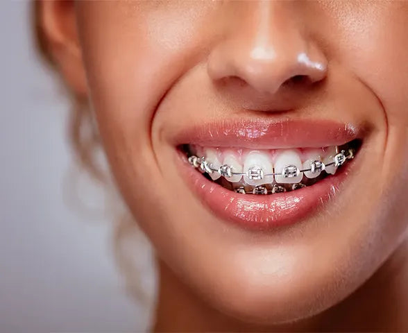 Why Flossing Is Essential While Wearing Braces